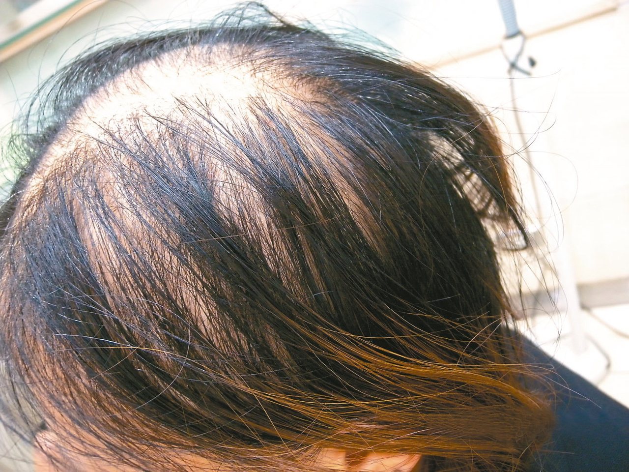 一名年近30的女性非常在意自己一頭長髮,只要多掉幾根頭髮,就焦慮不已,上皮膚科檢... 一名年近30的女性非常在意自己一頭長髮,只要多掉幾根頭髮,就焦慮不已,上皮膚科檢...