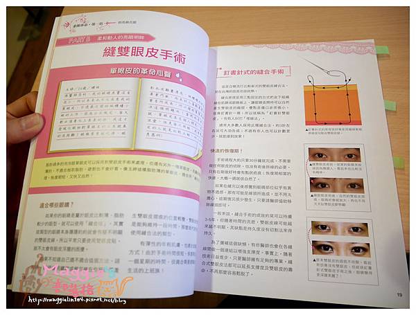 美麗爾縫雙眼皮 (7).JPG