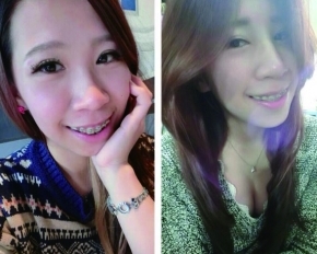打造立體五官♥隆鼻美型手術