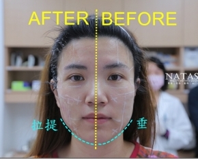 醫美│音波拉提│美麗爾醫學美容～時下最夯非侵入性臉部拉提技術。無傷口可立刻上妝