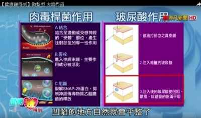 非凡電視台【健康賺得到】微整型 肉毒桿菌