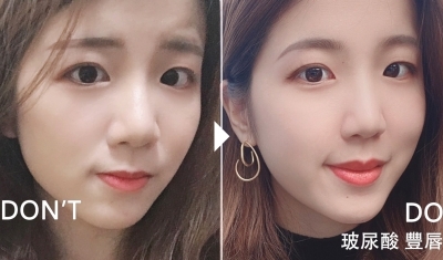 玻尿酸微笑唇 |同樣的微笑 不同的魅力| 自然展現嘟嘟唇 微笑唇 唇珠