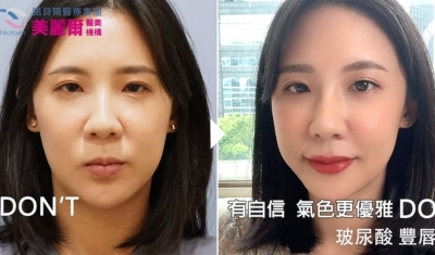 自然微笑唇 | 誘人嘟唇365天 陳美齡醫師 女神動態玻尿酸